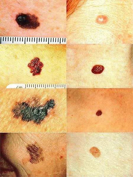 450px-Melanoma_vs_normal_mole_ABCD_rule_NCI_Visuals_Online.jpg