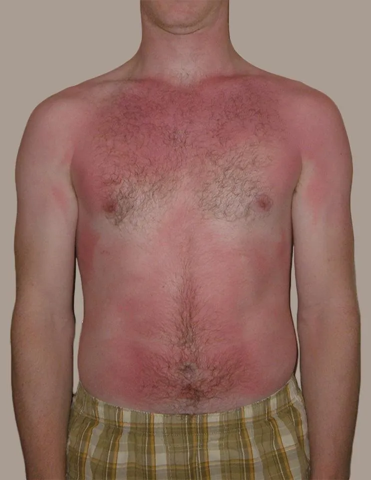 Sunburn.jpg