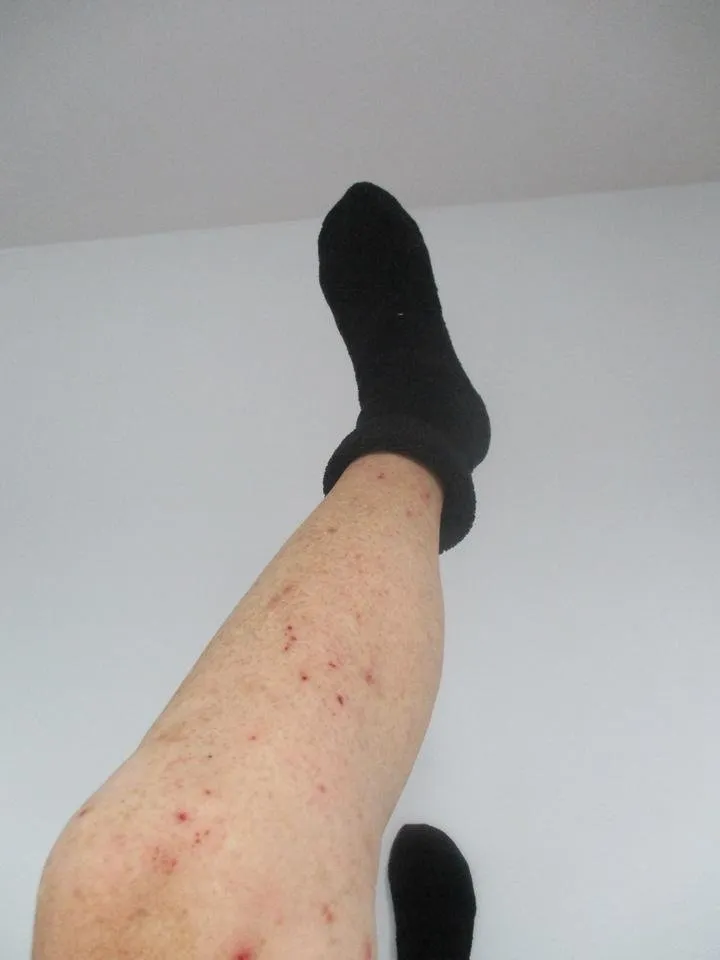fitinfun leg bites.JPG