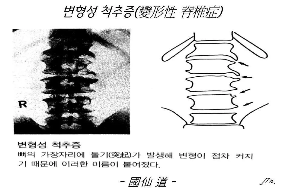 변형성 척추증1.jpg