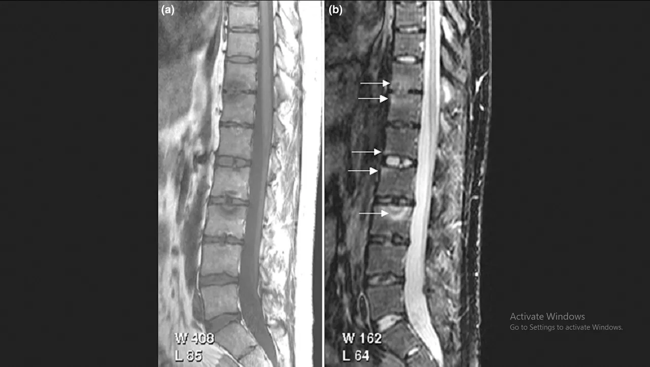 Psoriatic arthritis spine jpg credit Fiona McQueen, Marissa Lassere and Mikkel Østergaard 2.jpg