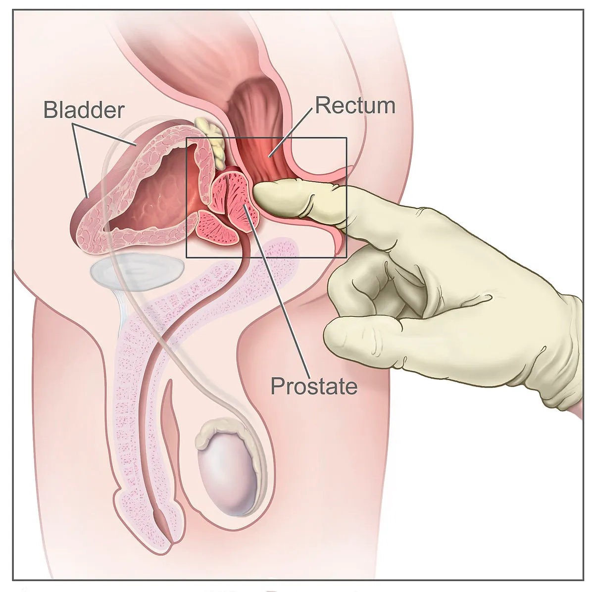 1200px-Digital_rectal_exam_nci-vol-7136-300.jpg