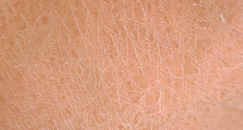 piel seca.jpg