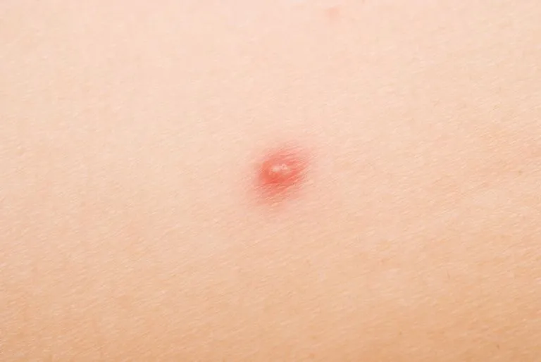 causes-of-acne-papules.jpg