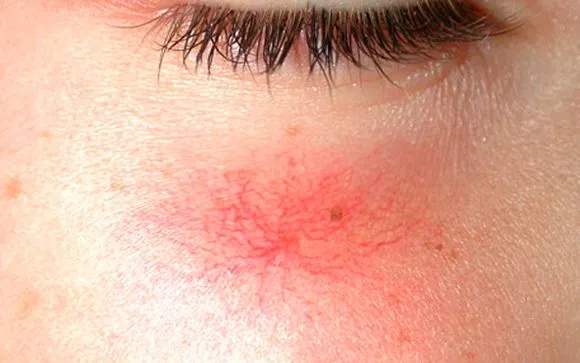 cuperosis_derma_18012016_estetic.jpg