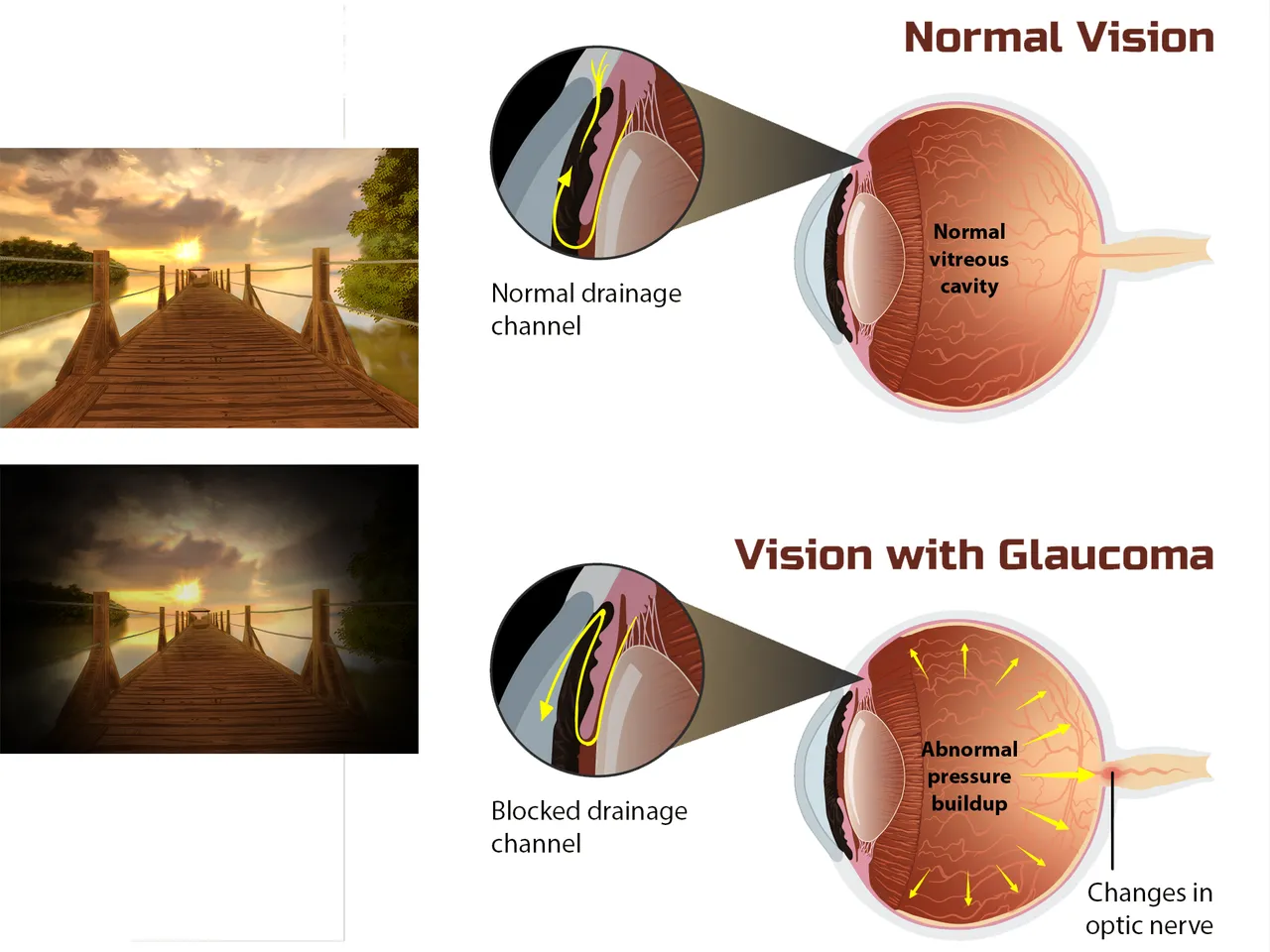 Glaucoma.png