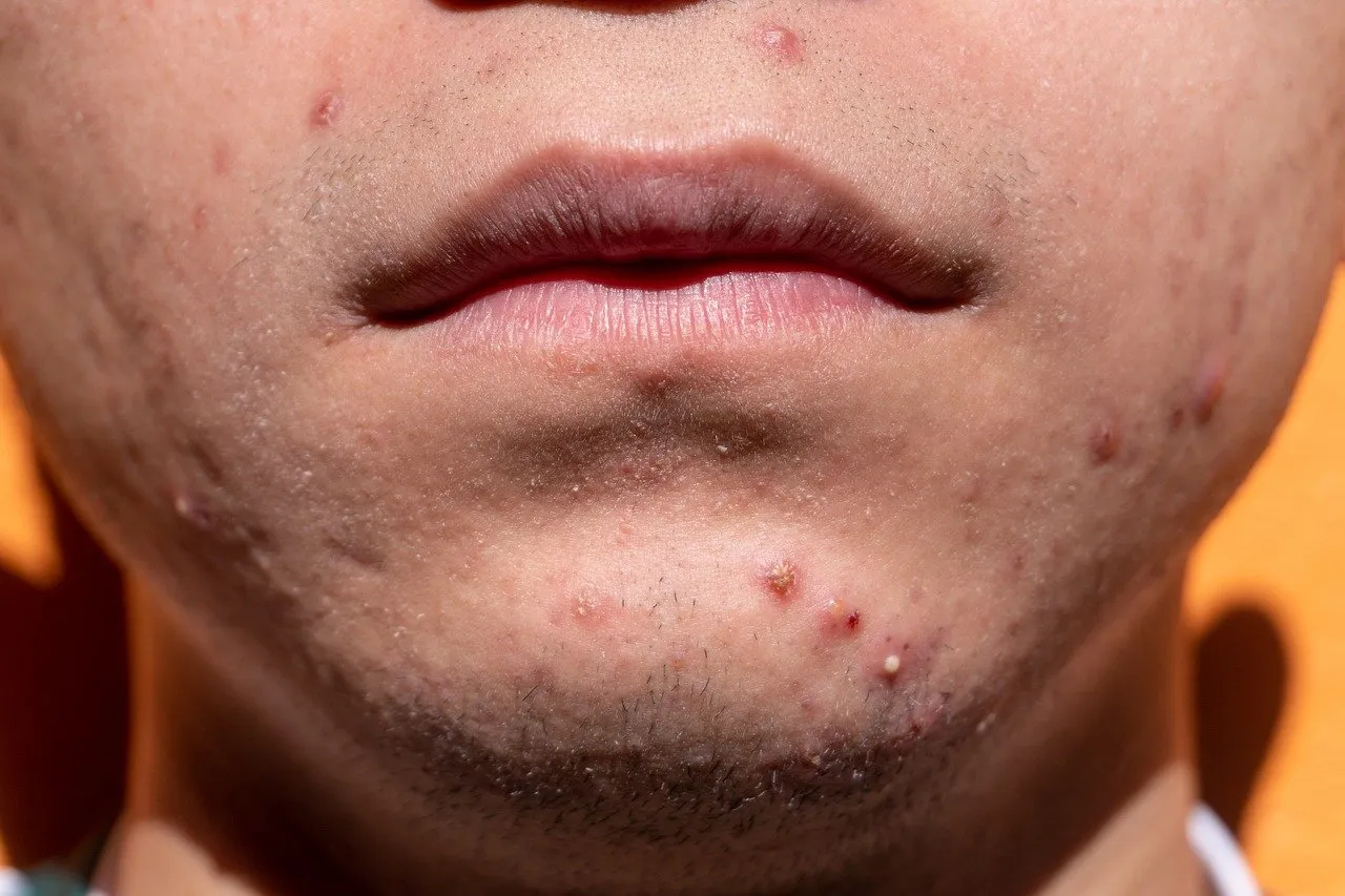acne-g0fa32a83f_1280.jpg