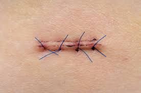 suture.jpg