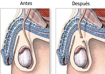 vasectomía-5.jpg