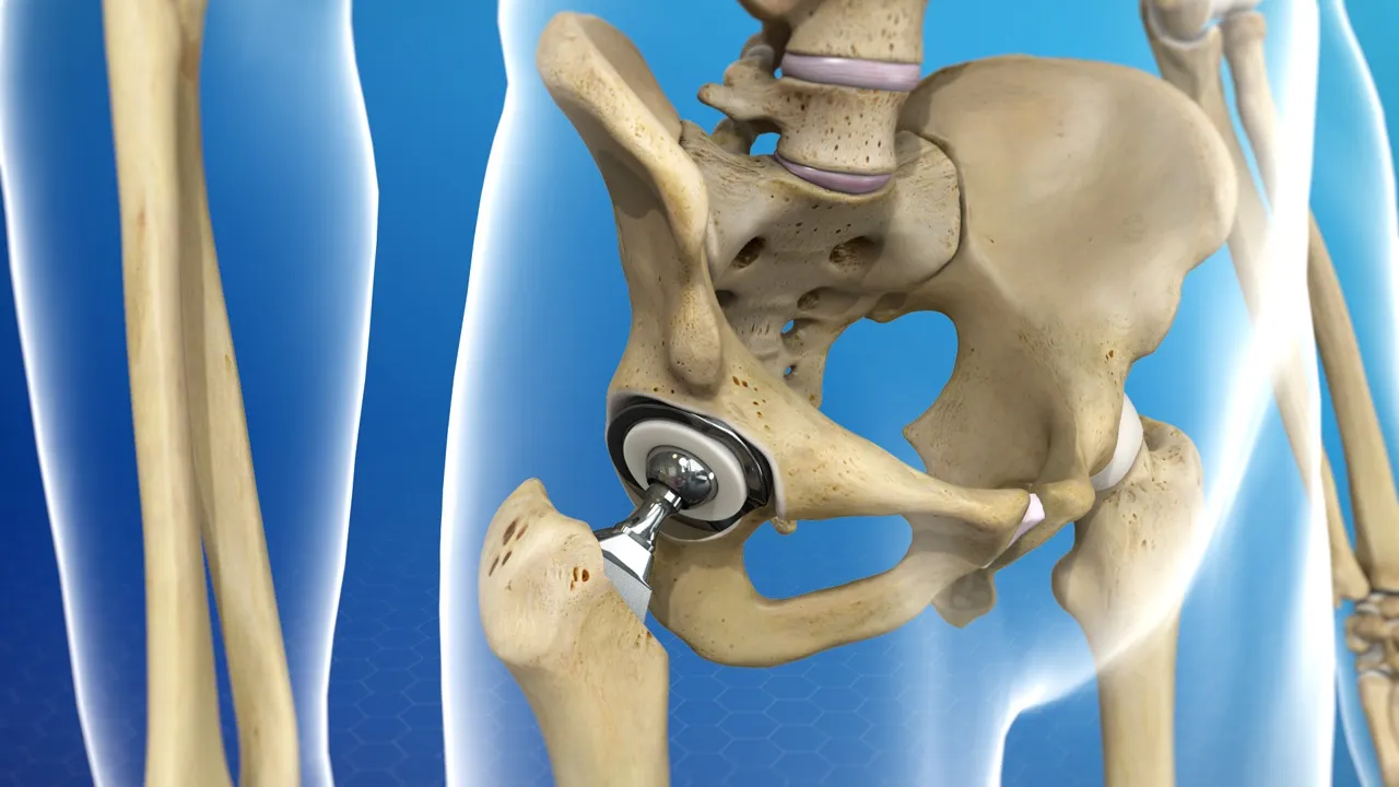 How to recover full functionality after a total hip replacement sur...