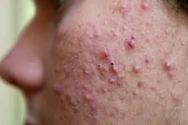 webmd_rf_photo_of_cystic_acne.jpg