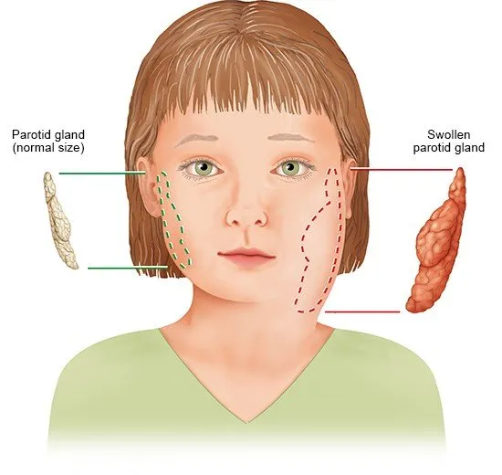 mumps_enjpg_replacement_image.jpg