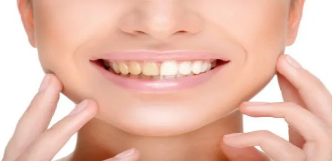 tooth-whitening(bleaching)-002.jpg