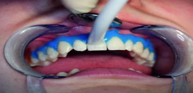 tooth-whitening(bleaching)-004.jpg