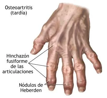 CBD-en-el-Tratamiento-de-Artritis_ec16b6f6-598c-4a8e-8447-3aa3bee4f88c_large.jpg