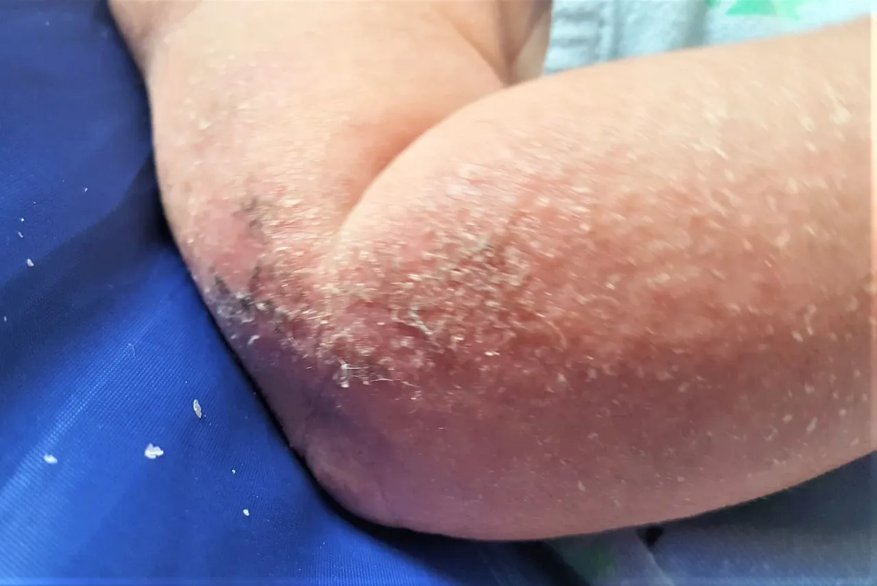 Eczema6.jpg