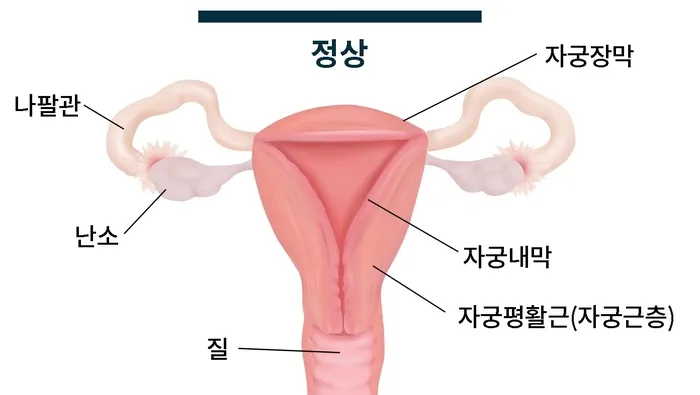 비뇨생식기 문제로 냉 - 종로부인과.jpg