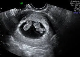 8 9 недель фото 8 9 недель фото