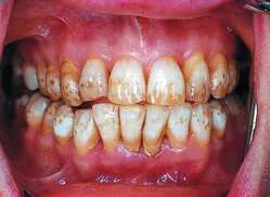 fluorosis.jpg