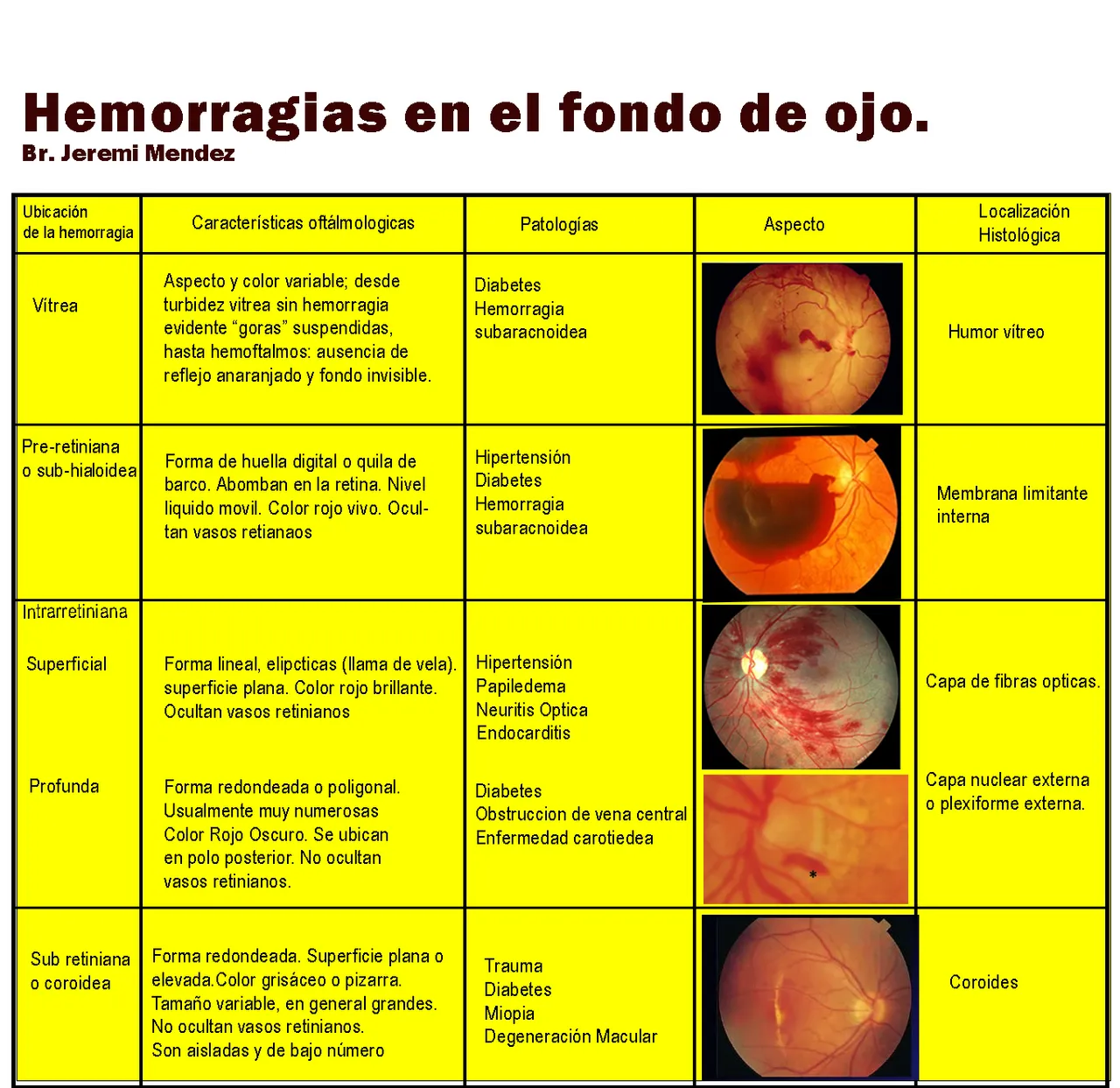 Hemorragias fondo de ojo.1.jpg