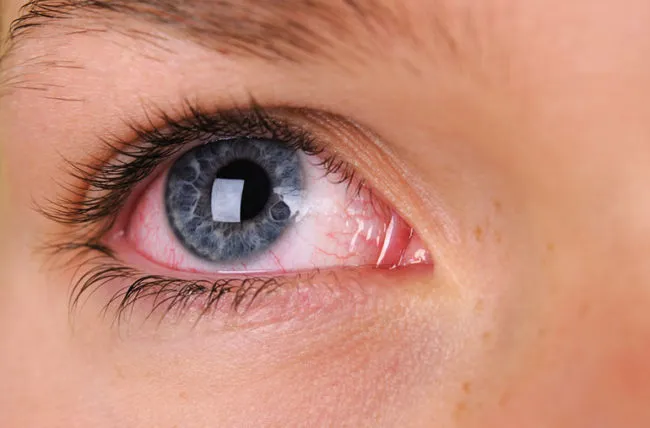 redEye-185255250-770x553-650x428 (1).jpg
