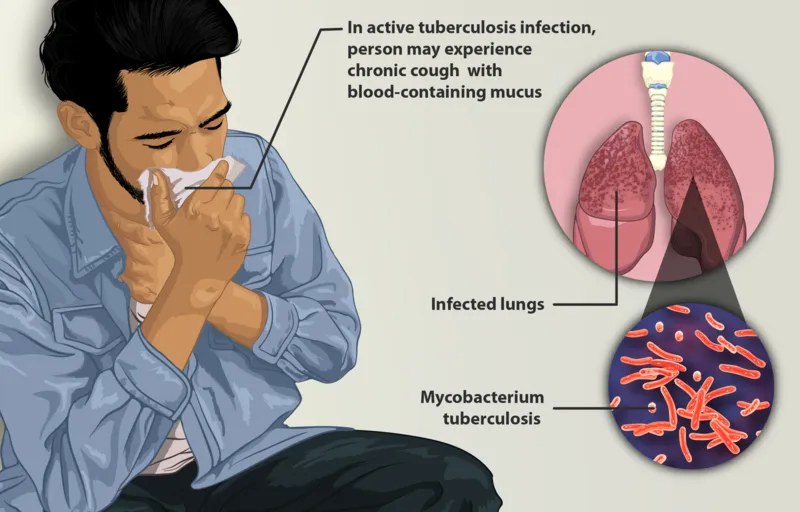 Depiction_of_a_tuberculosis_patient.png