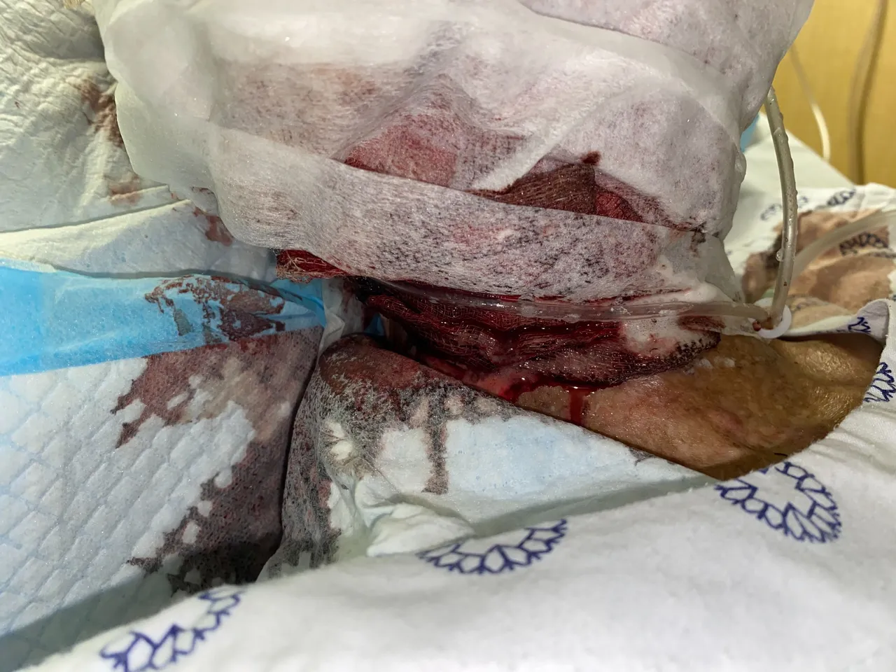Uncle's sarcoma is on his right cheek.  We change his gauze on a daily basis to prevent infection and manage bleeding