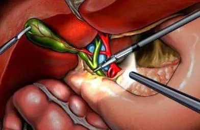 Gallstone_homeopathic_treatment_Bangladesh.jpg