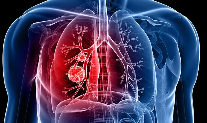 vitamin-d lung-cancer