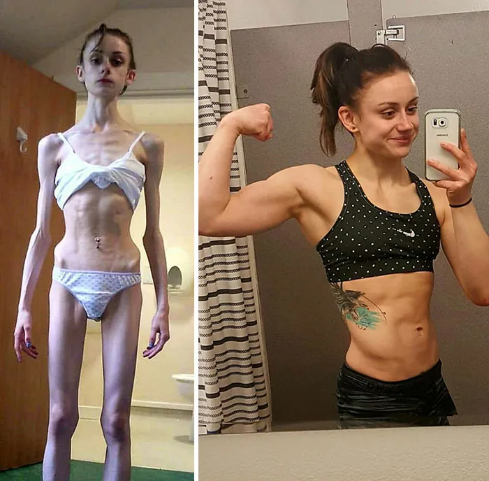 anorexia-recovery-before-after-101-58f5b1c3eb2c1__700.jpg