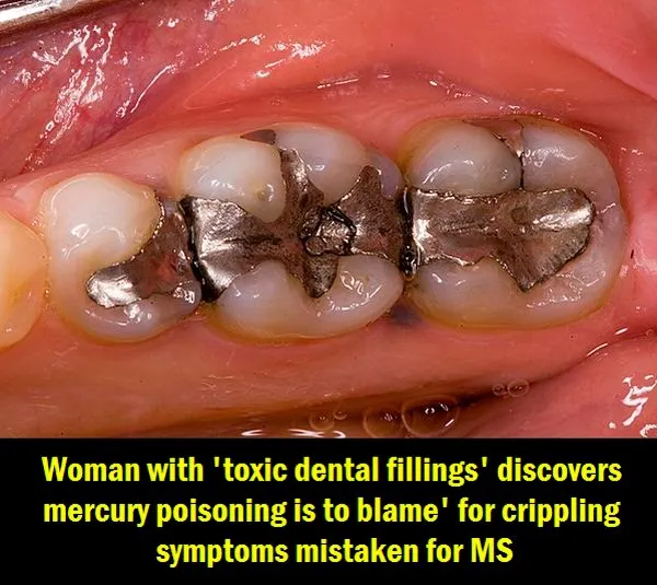 fillings.jpg