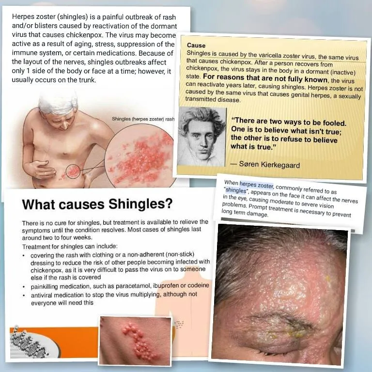shingles.jpg