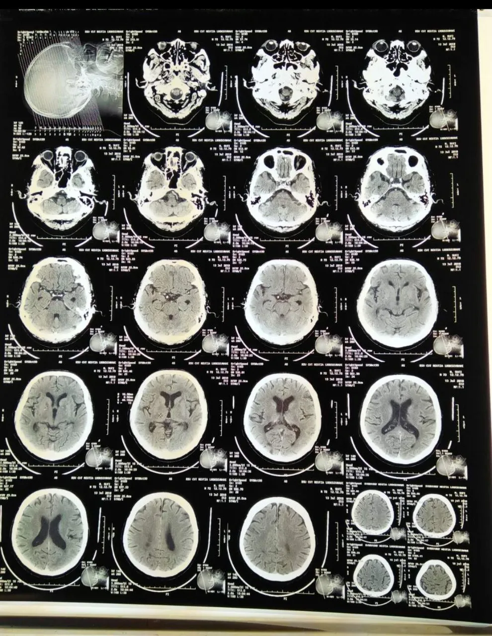 https://s3.us-east-2.amazonaws.com/partiko.io/img/pesonaku-brain-ct-scan-1531473299850.png