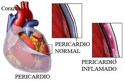 pericarditis.jpg