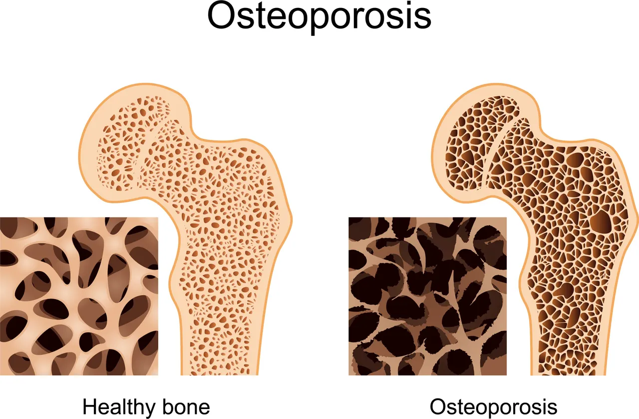 osteoporosis.jpg