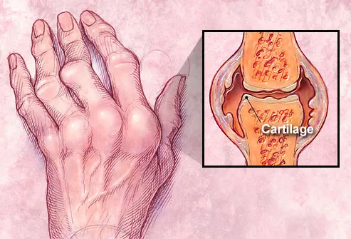 photolibrary_rf_illustration_of_joint_with_rheumatoid_arthritis..jpg