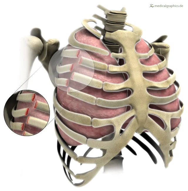 rib fracture