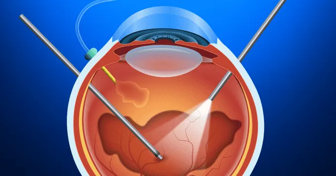 vitrectomy-1200x630.png