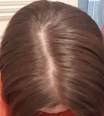 no poo experiment scalp week 2.jpg