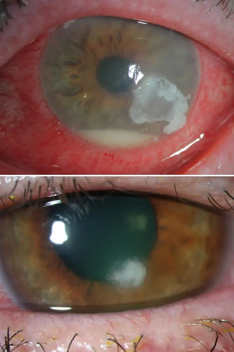 22524-corneal-ulcer.jpg.webp