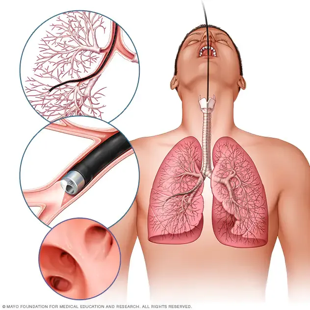 mcdc7_bronchoscopy-8col.webp