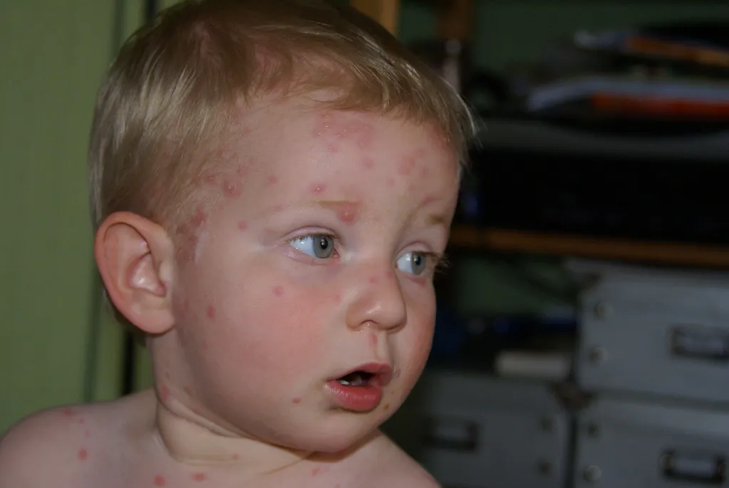 chickenpox