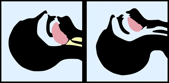 Tongue_blocking_airway.svg_640x317.jpg