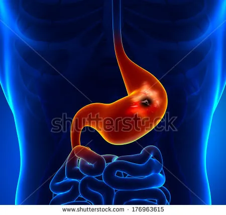 stock-photo-peptic-ulcer-176963615.jpg