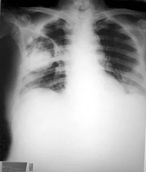 aspergillus4b Radiografia aspergiloma.jpg