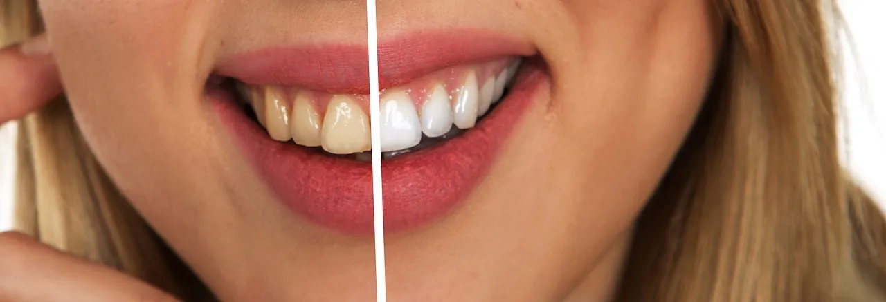 teeth-g917727737_1280.jpg