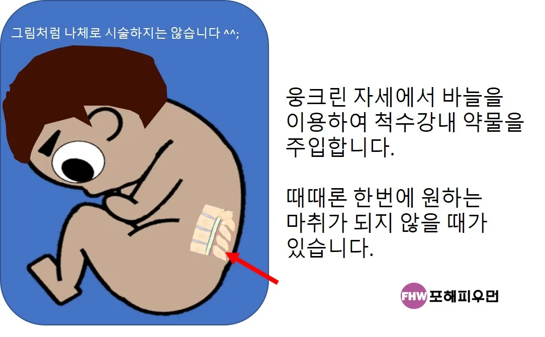 -제왕절개-척추마취