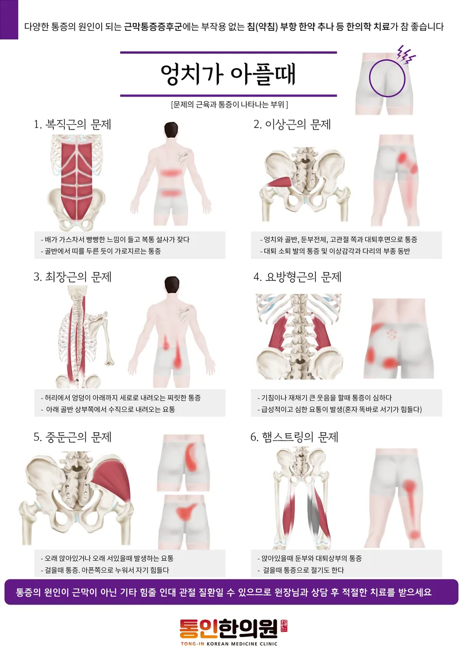 엉치아플때 종각한의원.jpg