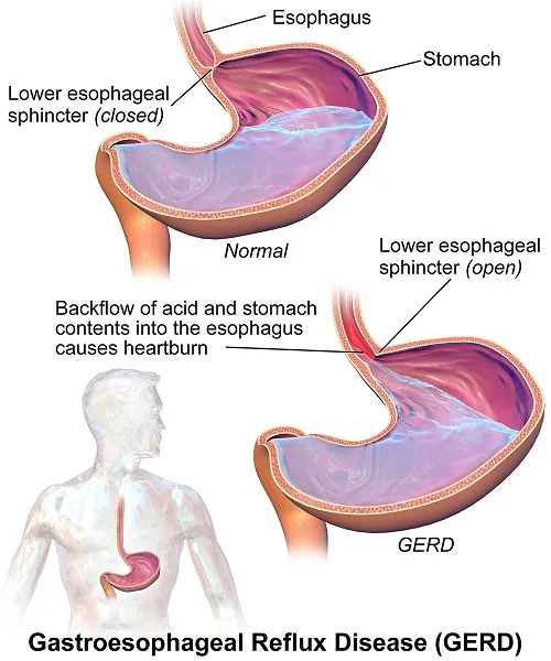 GERD Jpeg.jpg