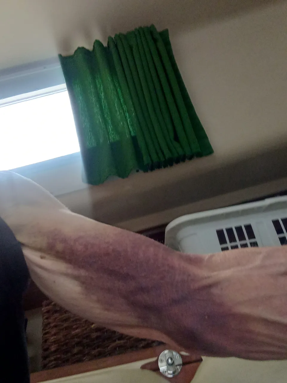 bruised-shoulder.jpg